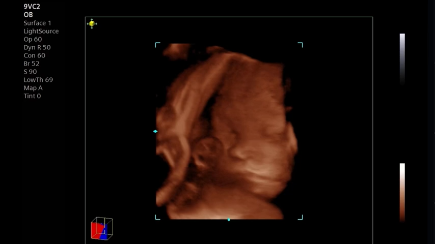 Siemens ACUSON Maple ultrasound screen displaying advanced lightsource rendering for high-precision 3D/4D fetal facial and anatomical imaging