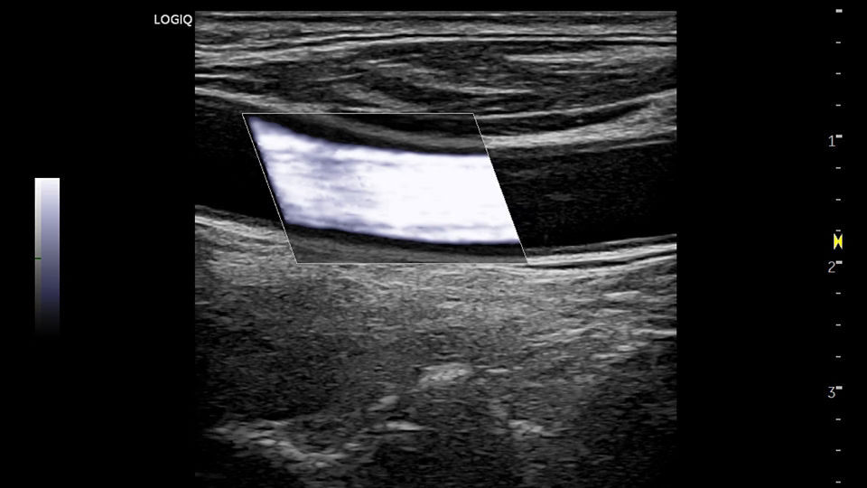 GE LOGIQ P10 XDclear B-Flow vascular imaging ultrasound scan showing blood flow dynamics
