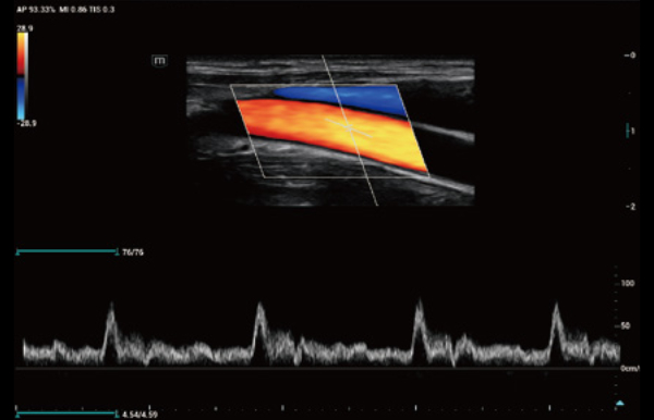 Mindray Consona vascular ultrasound image showing Common Carotid Artery (CCA) duplex scan with color flow mapping