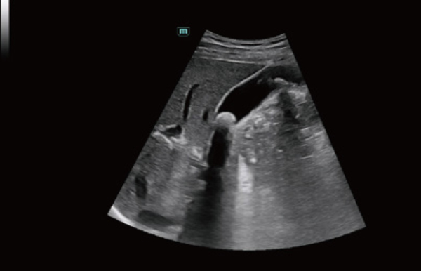 Mindray Consona clinical abdominal ultrasound image displaying gallstones with acoustic shadowing within the gallbladder