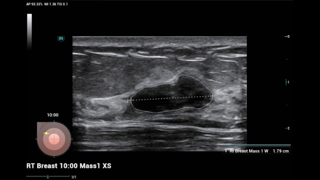 Mindray Consona automated Smart Breast lesion segmentation and ACR BI-RADS classification display