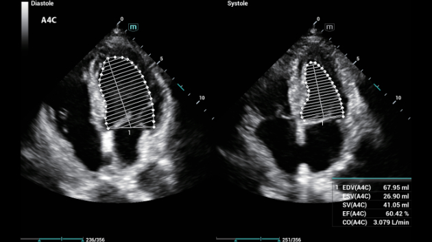 Mindray Consona N9 automated Auto EF measurement display for rapid left ventricular ejection fraction assessment