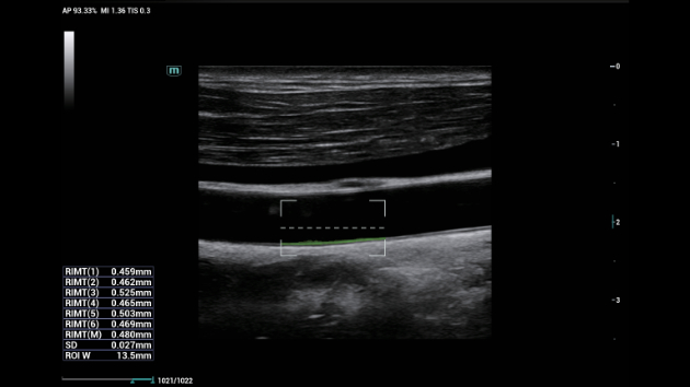 Consona N9 RIMT radio-frequency intima-media thickness measurement display for vascular assessment