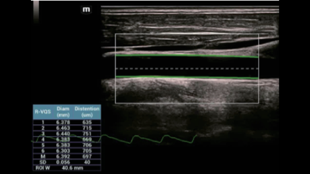 Mindray Consona N9 R-VQS radio-frequency vessel quantitative stiffness and arterial elasticity analysis display