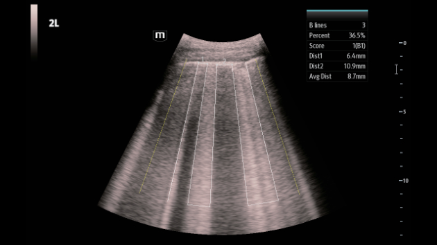 Mindray Consona N9 automated Smart B-Lines quantification display for lung ultrasound assessment