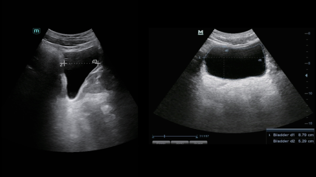 Mindray Consona N9 automated Smart Bladder measurement display for rapid urine volume and residual assessment