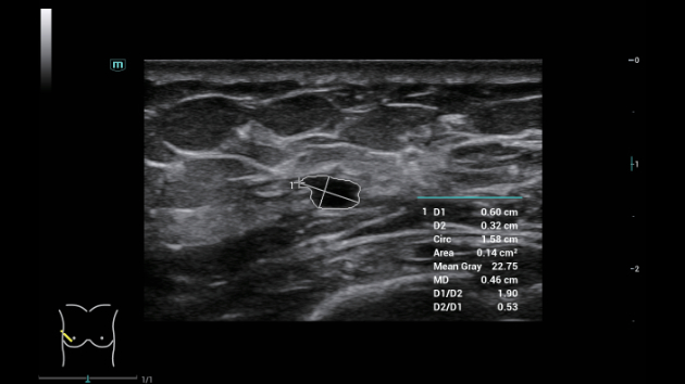 Mindray Consona N9 automated measurement tools and smart calculations display during a clinical ultrasound exam
