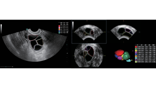 Mindray Consona N9 automated Smart FLC measurement display for rapid 3D follicle volume and count assessment