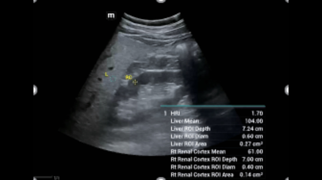 Mindray Consona N9 automated Smart HRI measurement display for quantitative liver fat and steatosis assessment
