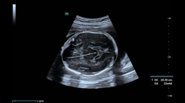 Mindray Consona N9 automated Smart OB fetal biometry measurement display for prenatal care