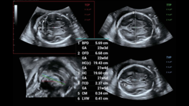 Mindray Consona N9 automated Smart Planes 3D and 4D ultrasound plane extraction display for fetal central nervous system imaging