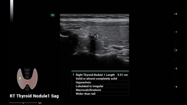 Mindray Consona N9 automated Smart Thyroid nodule measurement and TIRADS classification display