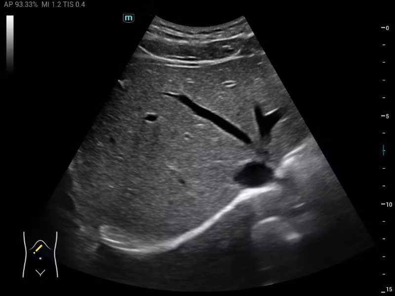 Mindray MX3 portable ultrasound system clinical image showing liver parenchyma evaluation and attenuation quantification