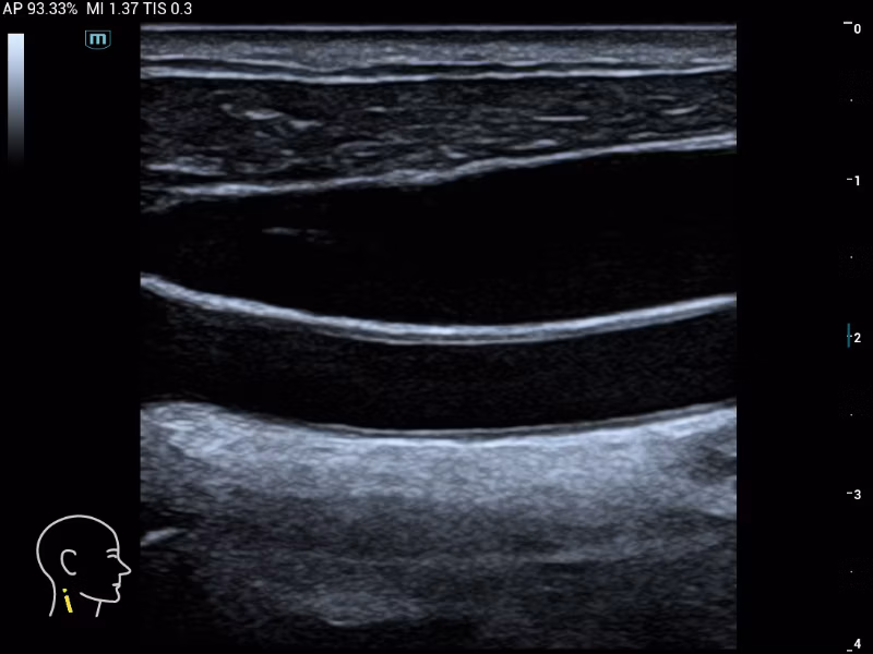 Mindray MX3 portable ultrasound system clinical B-mode image showing common carotid artery longitudinal view and vessel wall layers