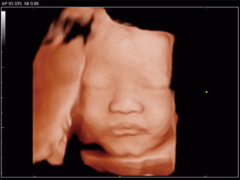 Mindray MX3 portable ultrasound system clinical 3D fetal face rendering showing high-resolution surface detail