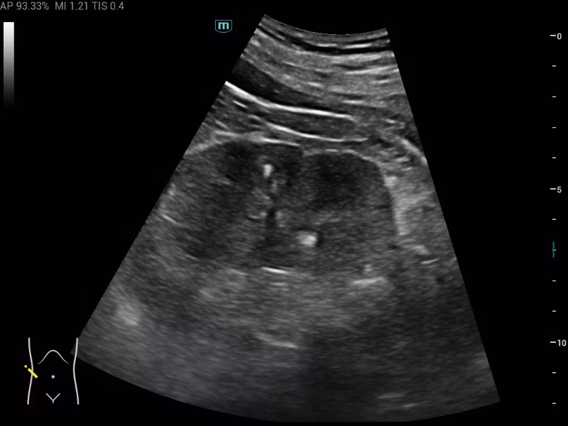 Mindray MX3 portable ultrasound system clinical image showing kidney parenchyma and renal pelvis evaluation