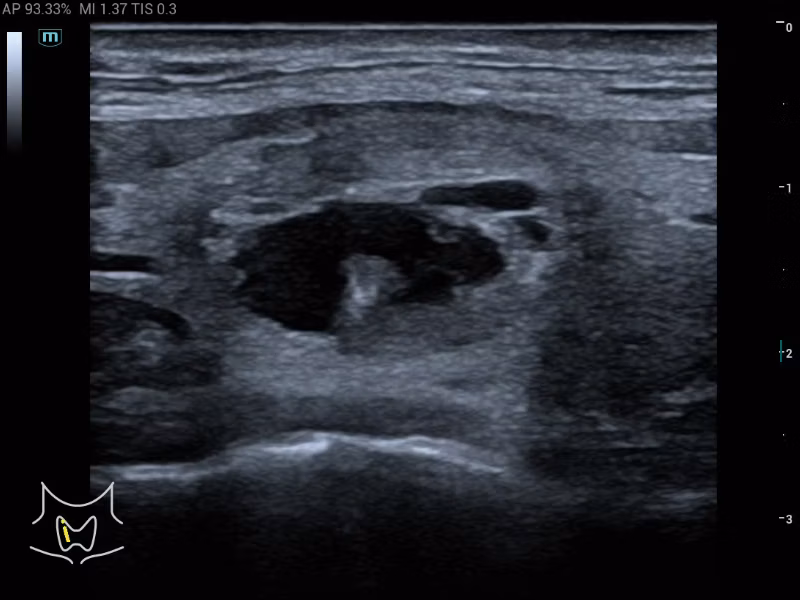 Mindray Consona series clinical ultrasound image displaying thyroid nodule segmentation and TI-RADS risk stratification
