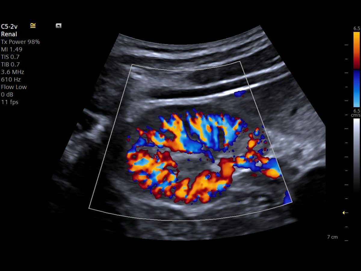 Siemens ACUSON Maple ultrasound screen displaying color Doppler pediatric or adult kidney scan with color autoflash suppression