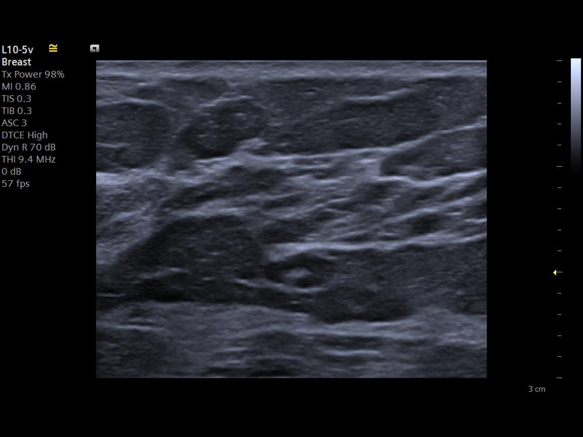 Siemens ACUSON Maple ultrasound screen displaying breast imaging utilizing speed of sound technology for enhanced tissue characterization