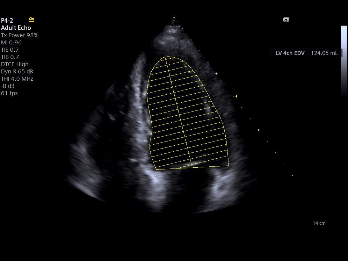 Siemens ACUSON Maple ultrasound screen displaying eSie Left Heart automated cardiac measurement workflow