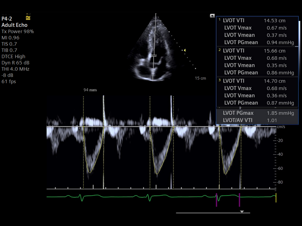 Siemens ACUSON Maple ultrasound screen displaying eSieMeasure automated measurement workflow