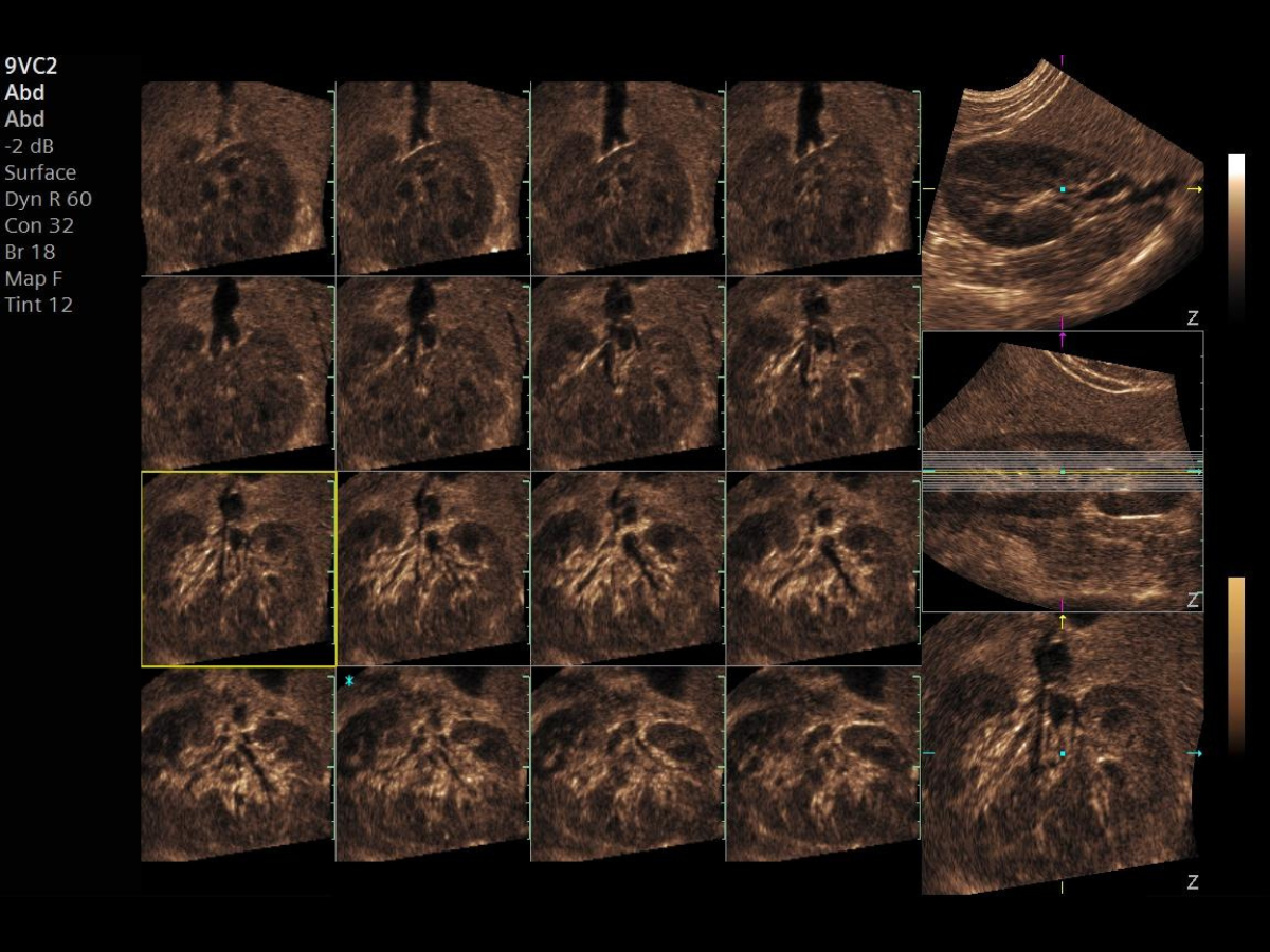 Siemens ACUSON Maple ultrasound screen displaying advanced 4Sight volume rendering technology for high-definition 3D/4D anatomical and structural visualization