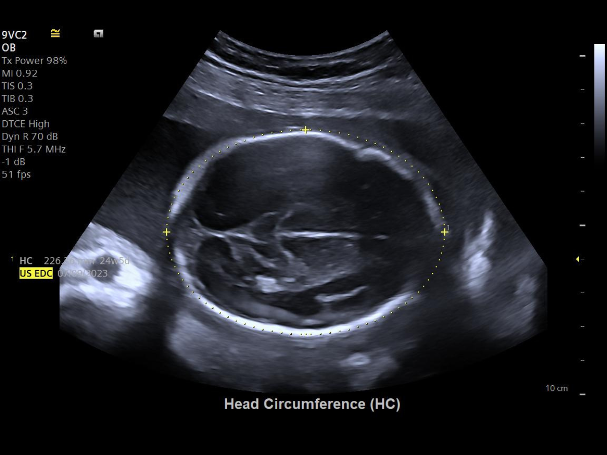 Siemens ACUSON Maple ultrasound screen displaying syngo Auto OB automated biometry measurements