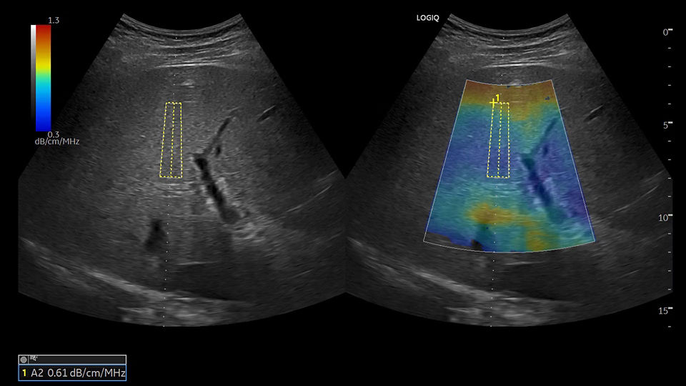 E LOGIQ P10 XDclear liver 2D shear wave elastography and UGAP scan for chronic liver disease assessment